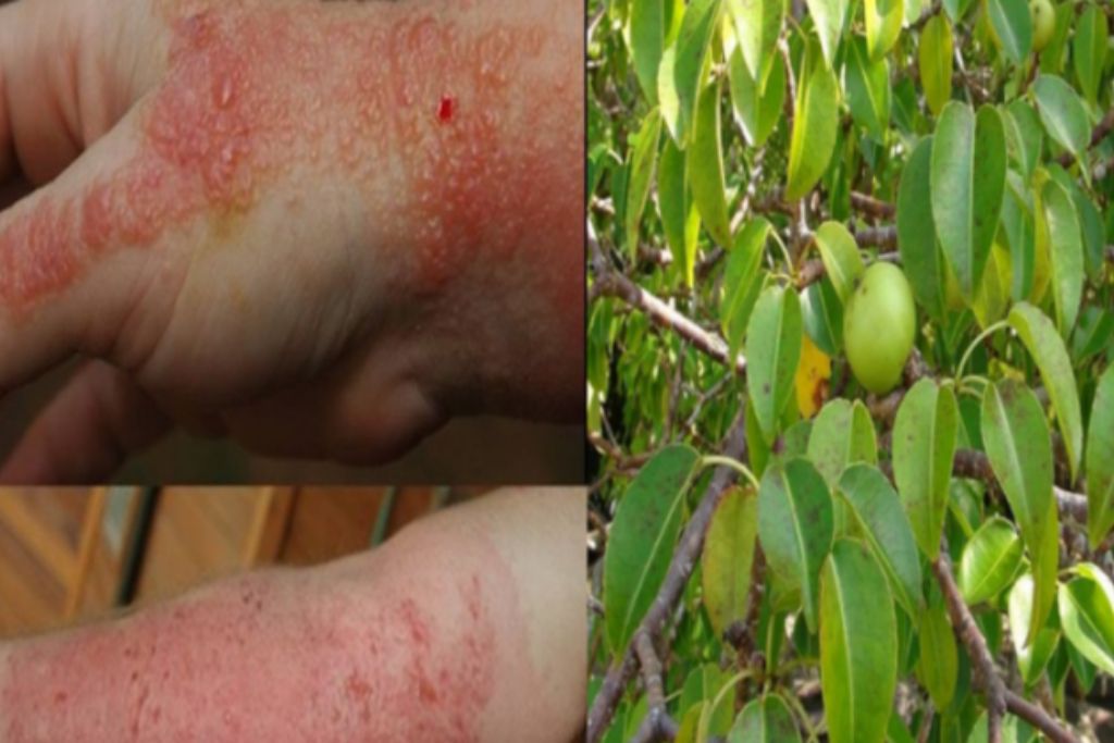 Worlds deadliest Tree manchineel burns skin in rain