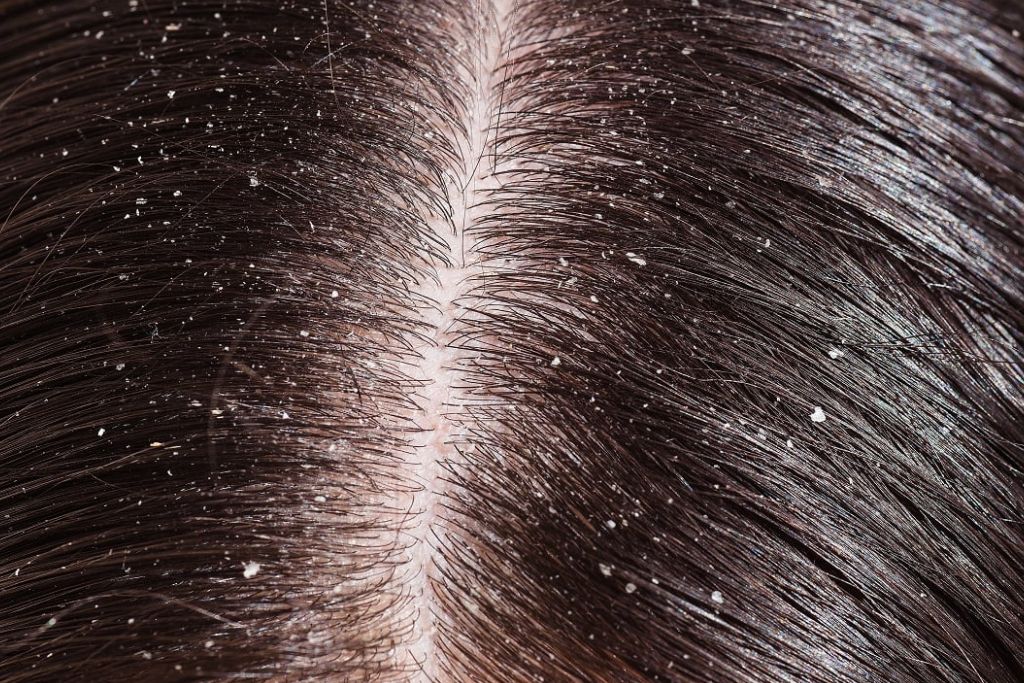 dandruff-home-remedies